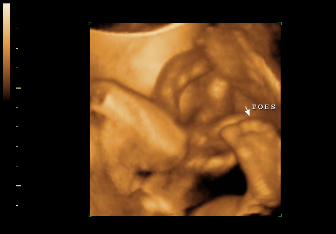3D ultrasound image at 28 weeks